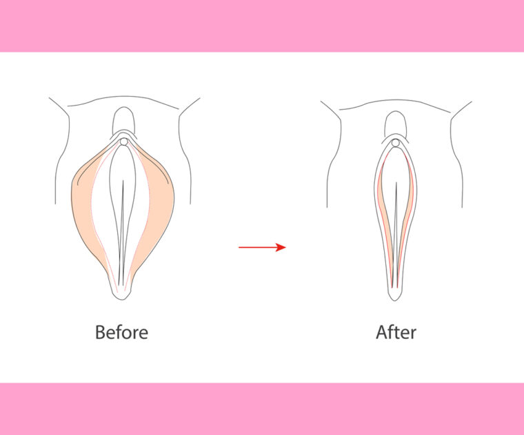Graphic of labia before and after labiaplasty